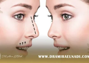 تجميل-الانف-بدون-جراحة