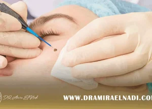 زالة-الزوائد-الجلدية-بالليزر